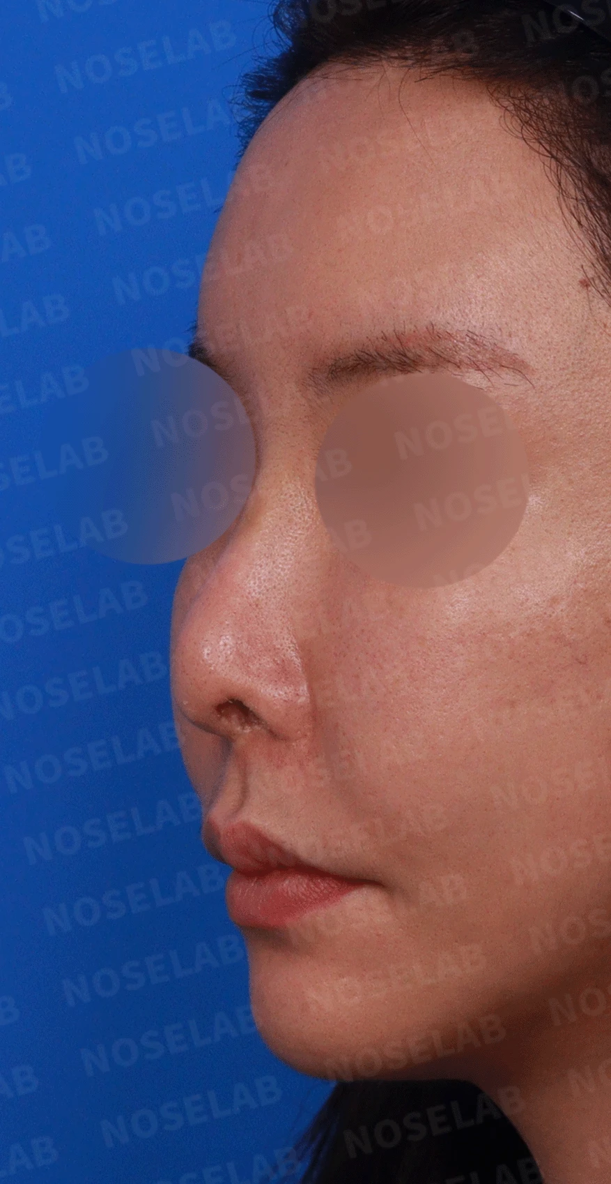 인공진피 이식 후 코끝이 비쳐 보이는 이유와 자가 늑연골 재건 방법 — 디자인 상담 정면 , 좌측 비스듬한 측면 , 측면 사진입니다.
