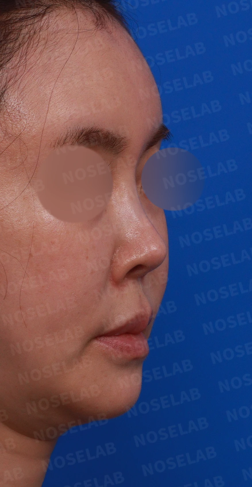 들린 코와 손상된 지지 구조의 재건 방법 — 디자인 상담 우측 비스듬한 측면, 측면, 비공 사진입니다.