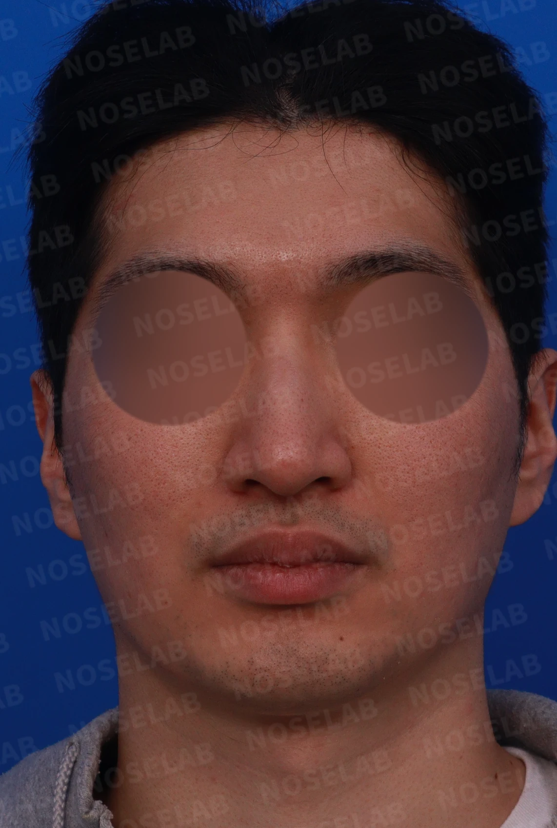 매부리코에 코막힘이 함께 오는 이유, 자가 늑연골만으로 하는 교정 방법 — 디자인 상담 정면, 좌측 측면, 비스듬한 측면 사진