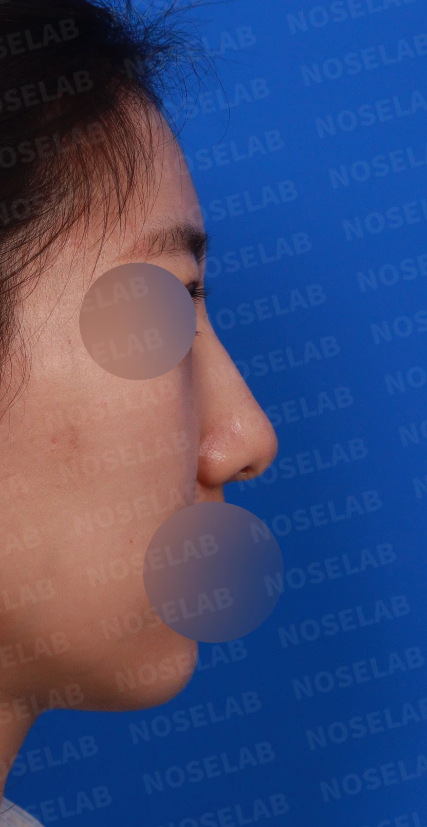 매부리를 정리한 뒤 콧등이 눌려 보이고 코끝이 뭉툭해지는 이유, 보형물 없이 교정하는 방법 — 디자인 상담 우측 측면, 비스듬한 측면, 비공 사진