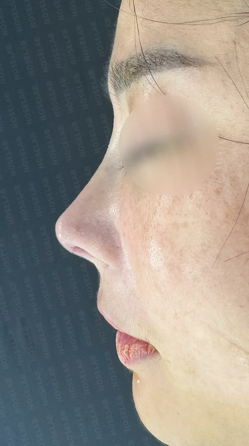 짧은 코와 코막힘을 함께 교정하는 방법 — 수술 직후 0일 정면, 비스듬한 측면, 측면 사진입니다. 직후 사진은 부기가 있는 상태로 최종 결과와 다를 수 있습니다.