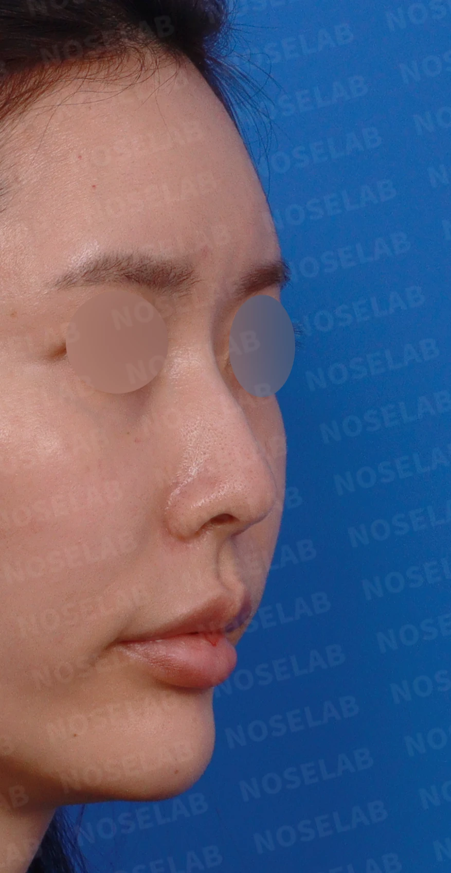 작고 처진 코와 코막힘이 함께 있을 때의 교정 방법 — 디자인 상담 우측 측면, 비스듬한 측면, 비공 사진입니다