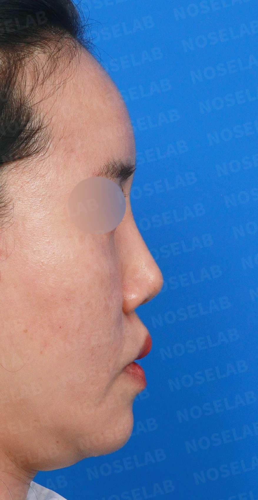 메드포어를 넣은 코에 코막힘이 생기는 이유, 제거와 자가늑연골 비중격 재건은 어떻게 하나 — 디자인 상담 우측 측면, 비스듬한 측면, 비공 사진입니다.