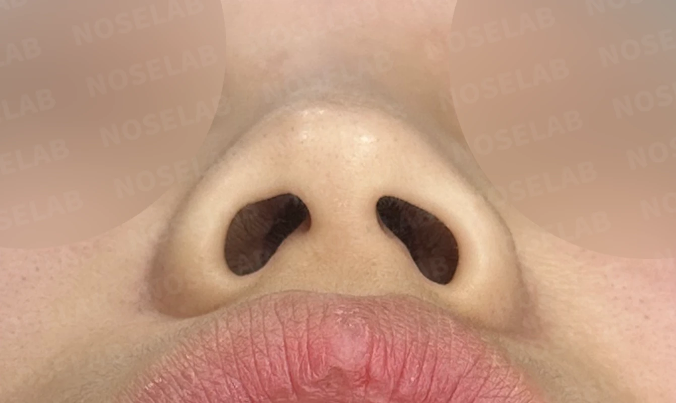 무보형물 코성형, 휘어진 콧대와 처진 코끝을 자연스럽게 교정 — 전(좌) 직후(후)