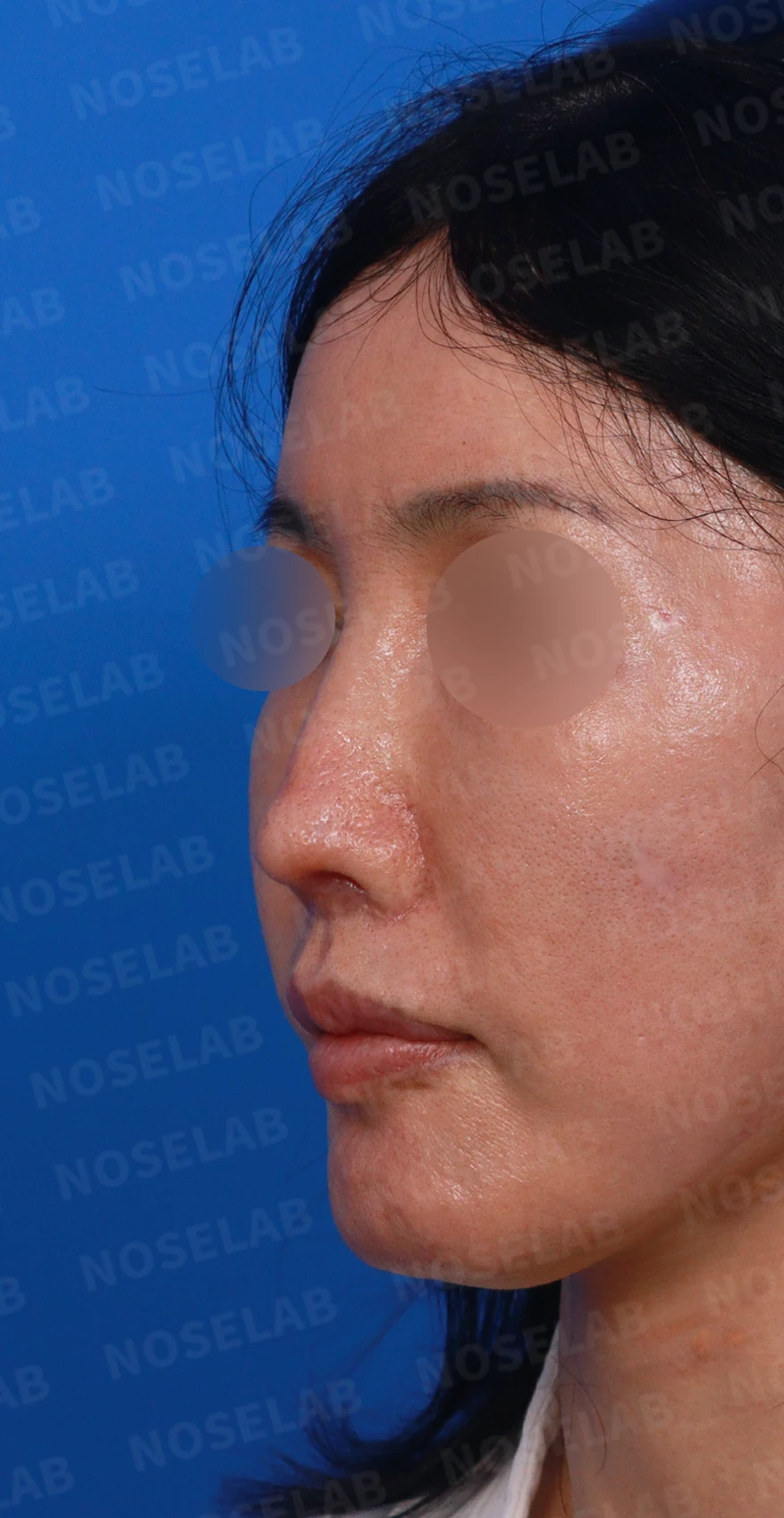 여러 차례 수술 뒤 비중격이 손상되면, 늑연골 재건은 어떻게 하나 — 디자인 상담 정면, 좌측 측면, 비스듬한 측면 사진입니다.