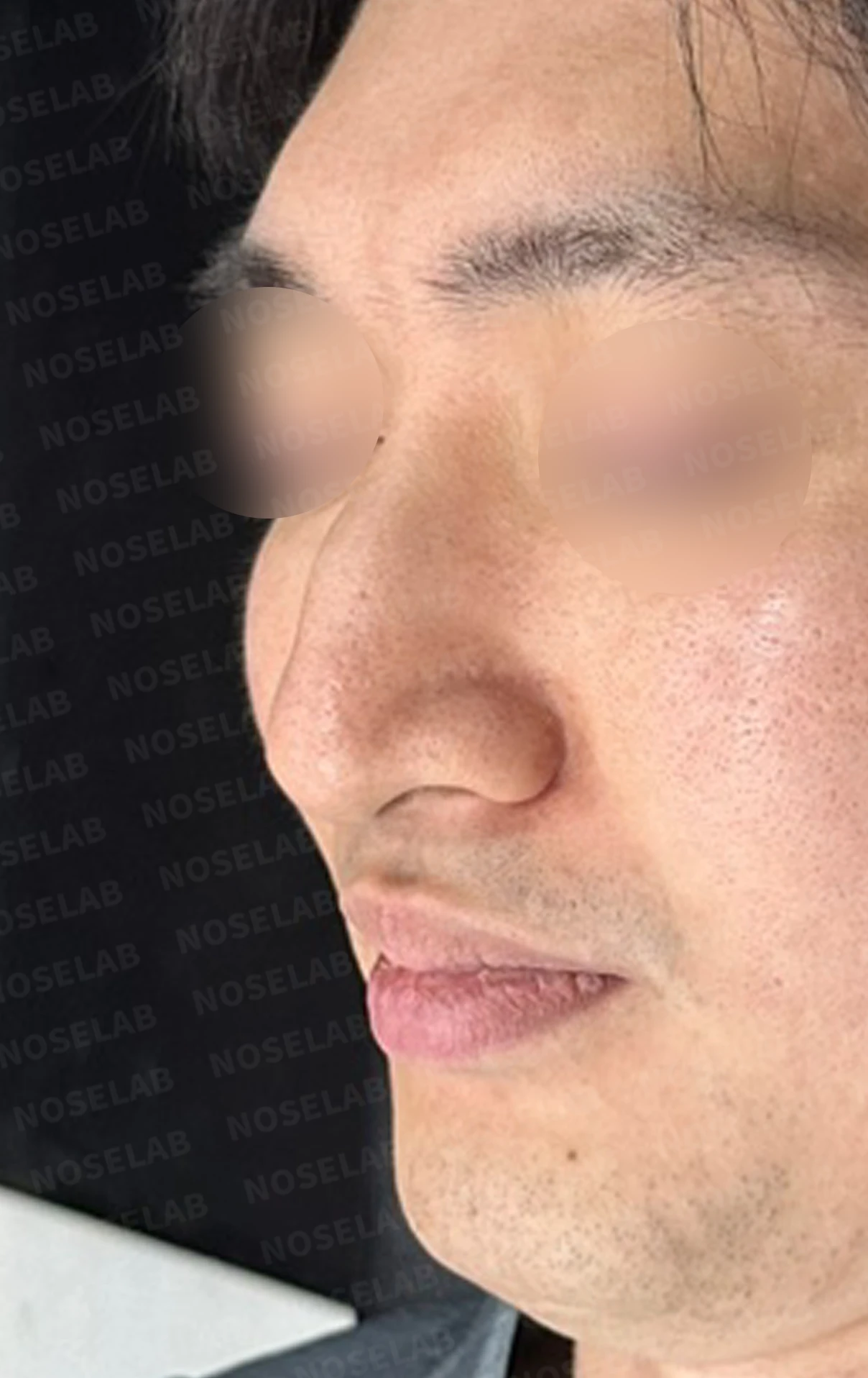 매부리코에 코막힘이 함께 오는 이유, 자가 늑연골만으로 하는 교정 방법 — 수술 전 / 수술 직후 0일 직후 사진은 부기가 있는 상태로 최종 결과와 다를 수 있습니다.