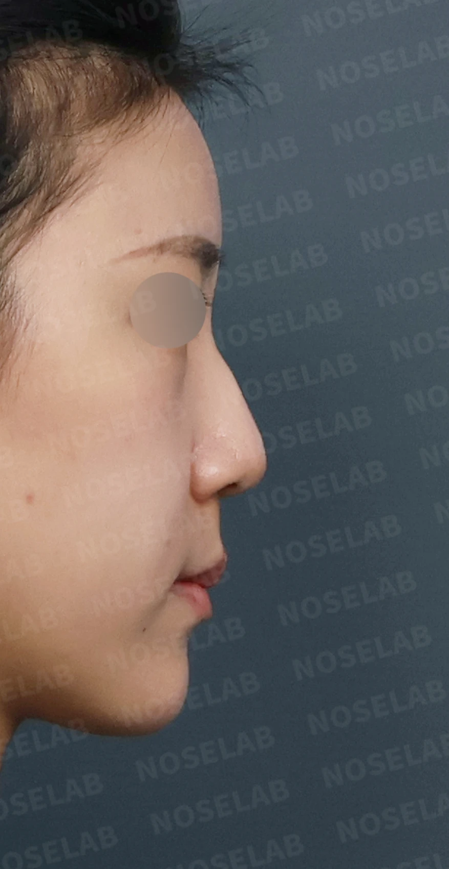 코필러 제거 후 자가늑연골 코성형, 처진 코끝과 메부리코를 자연스럽게 교정 — 디자인 상담 우측 측면, 비스듬한 측면, 비공 사진입니다.