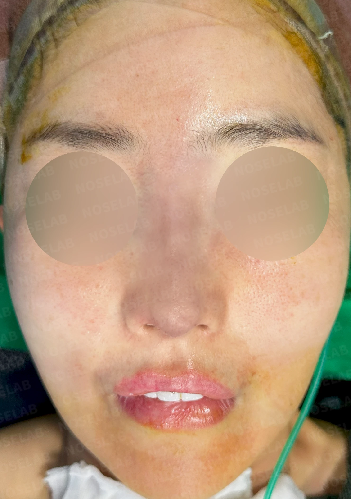 긴 코와 비대칭을 함께 교정하는 재수술 방법 — 수술 직후 0일 정면, 측면, 비스듬한 측면 사진 직후 사진은 부기가 있는 상태로 최종 결과와 다를 수 있습니다.