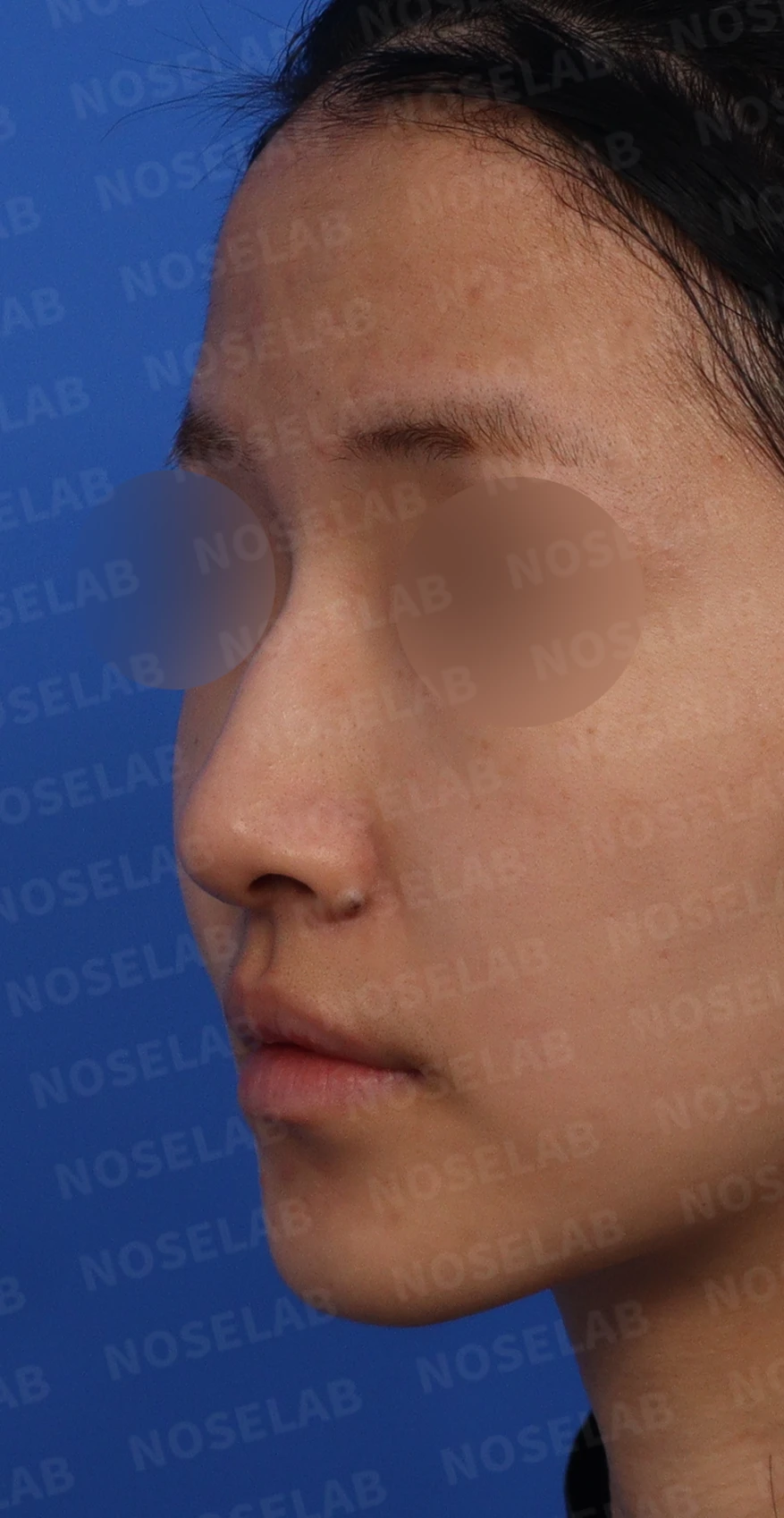 긴 코와 매부리코, 얼굴 비율을 고려한 교정 방법 — 디자인 상담 좌측 비스듬한 측면, 측면, 콧구멍 사진입니다.