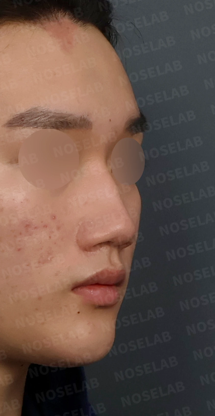 휜코 매부리코 교정, 남자 코성형으로 자연스러운 변화 — 디자인 상담 우측 측면, 비스듬한 측면, 비공 사진입니다.