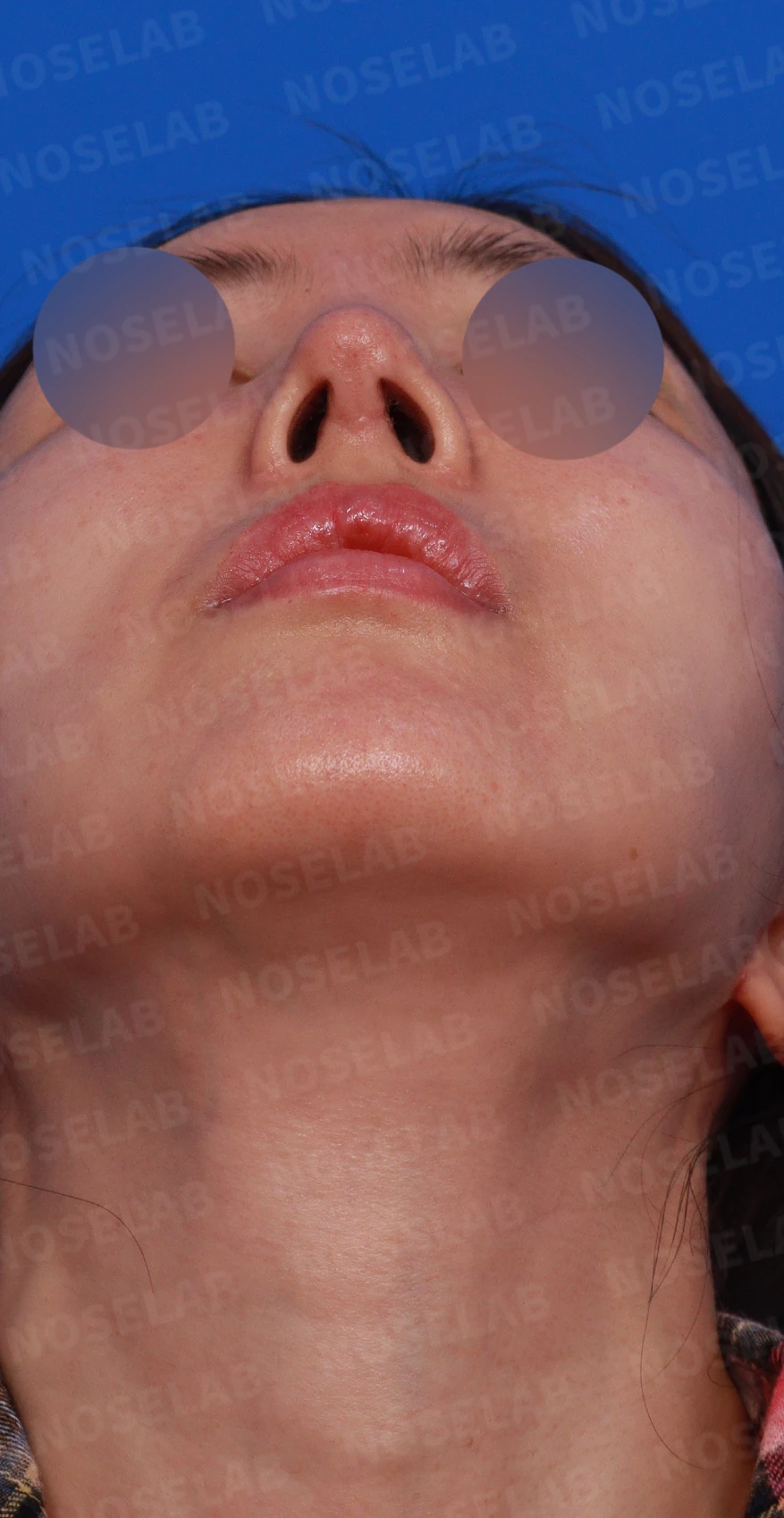 긴 코와 비대칭을 함께 교정하는 재수술 방법 — 디자인 상담 우측 측면, 비스듬한 측면, 비공 사진