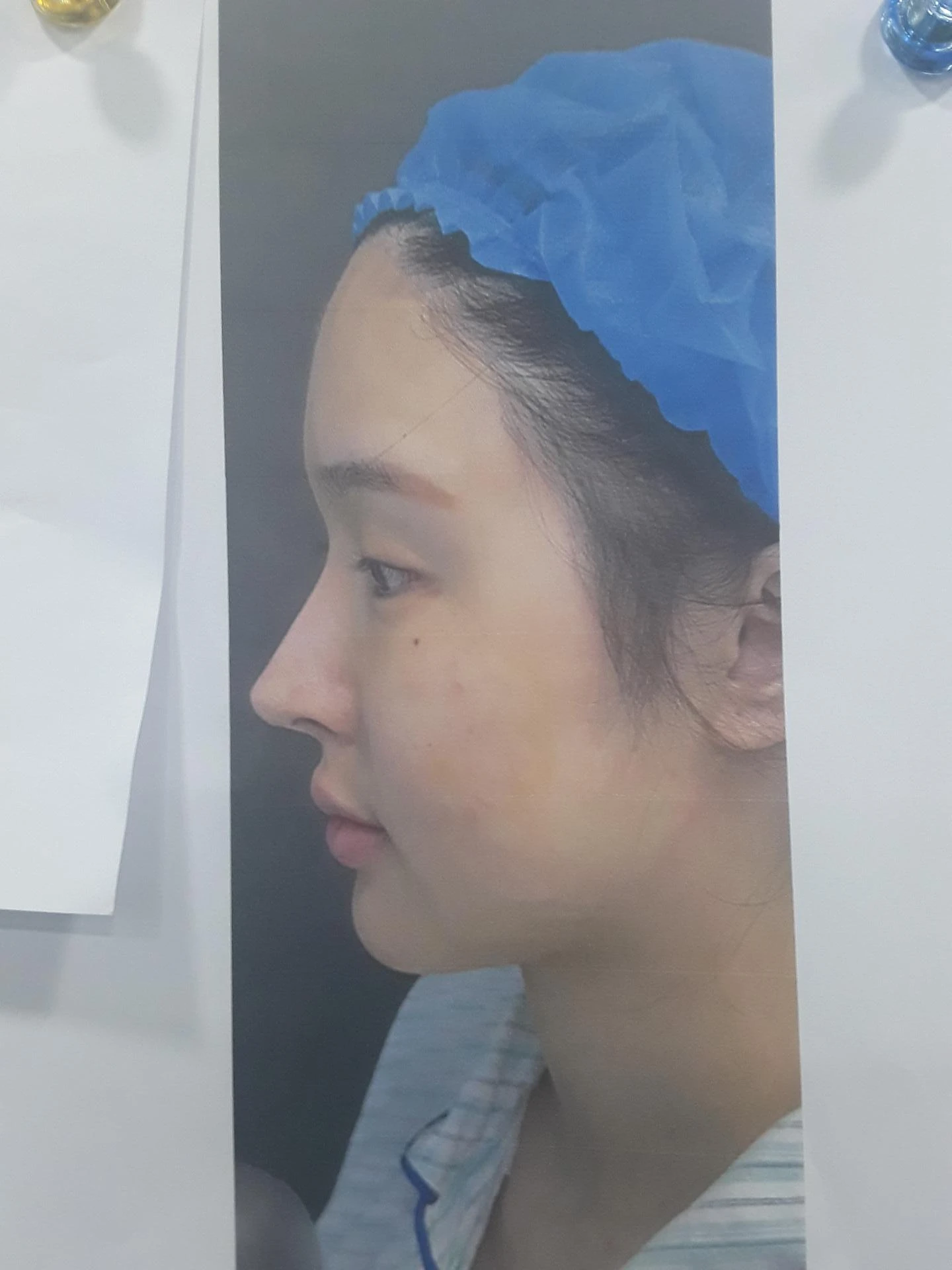 코재수술 뒤 콧대가 붉어 보이는 이유와 재건 방법 — 환자분 원하시는 이미지 사진들입니다.