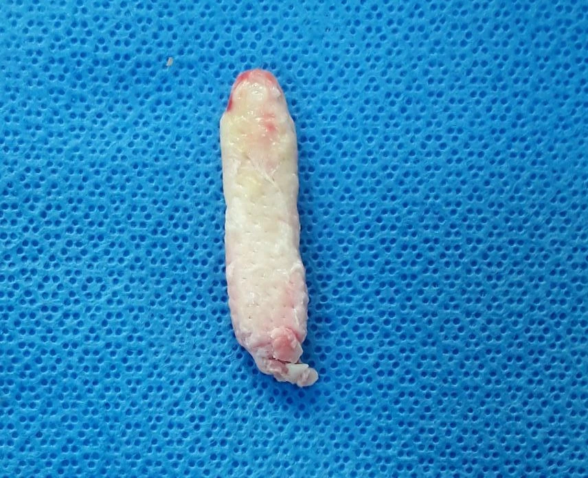 인공진피 이식 후 코끝이 비쳐 보이는 이유와 자가 늑연골 재건 방법 — 제거된 콧등 인공진피 사진