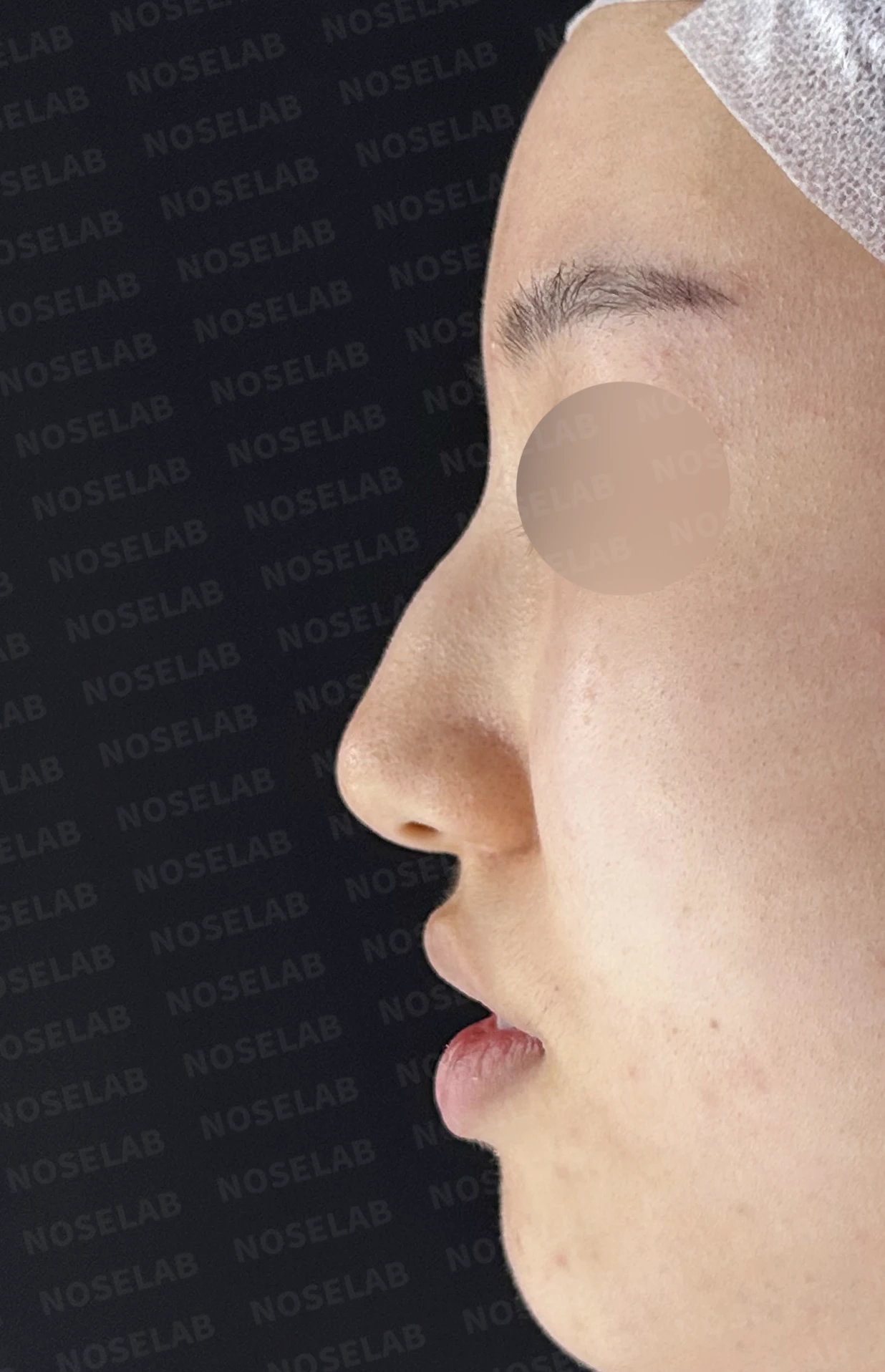 매부리코와 긴코 교정, 자가늑연골로 오똑한 코끝과 코막힘까지 해결 — 전(좌) 직후(후)