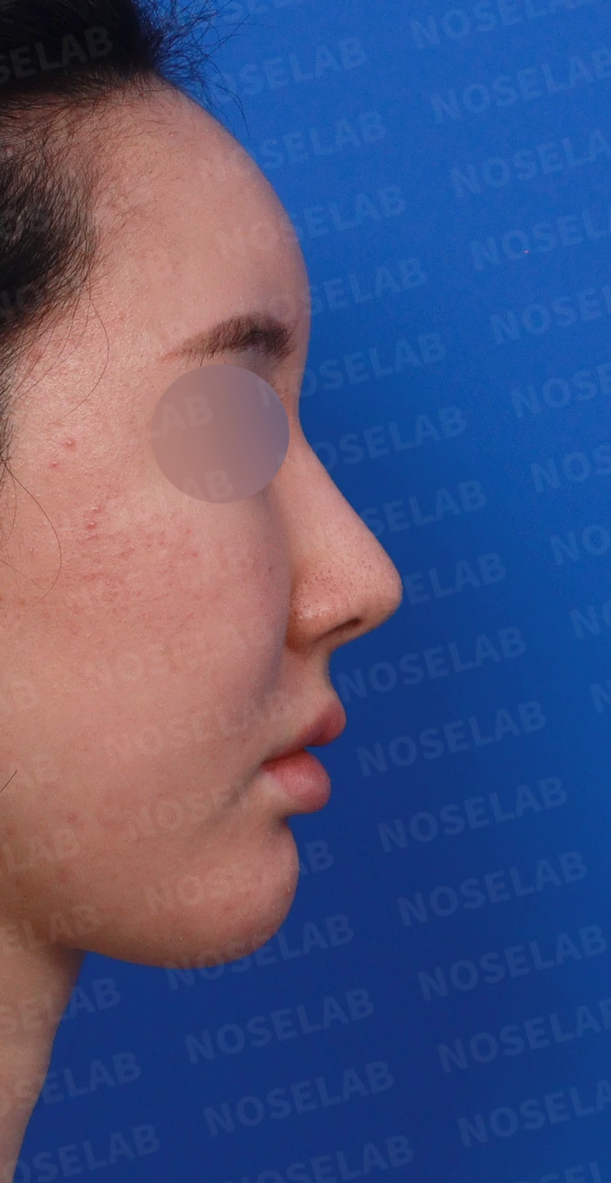 코가 길어 보이고 비주가 휘는 이유, 비중격 연장과 재건은 어떻게 하나 — 디자인 상담 우측 측면, 비스듬한 측면, 비공 사진