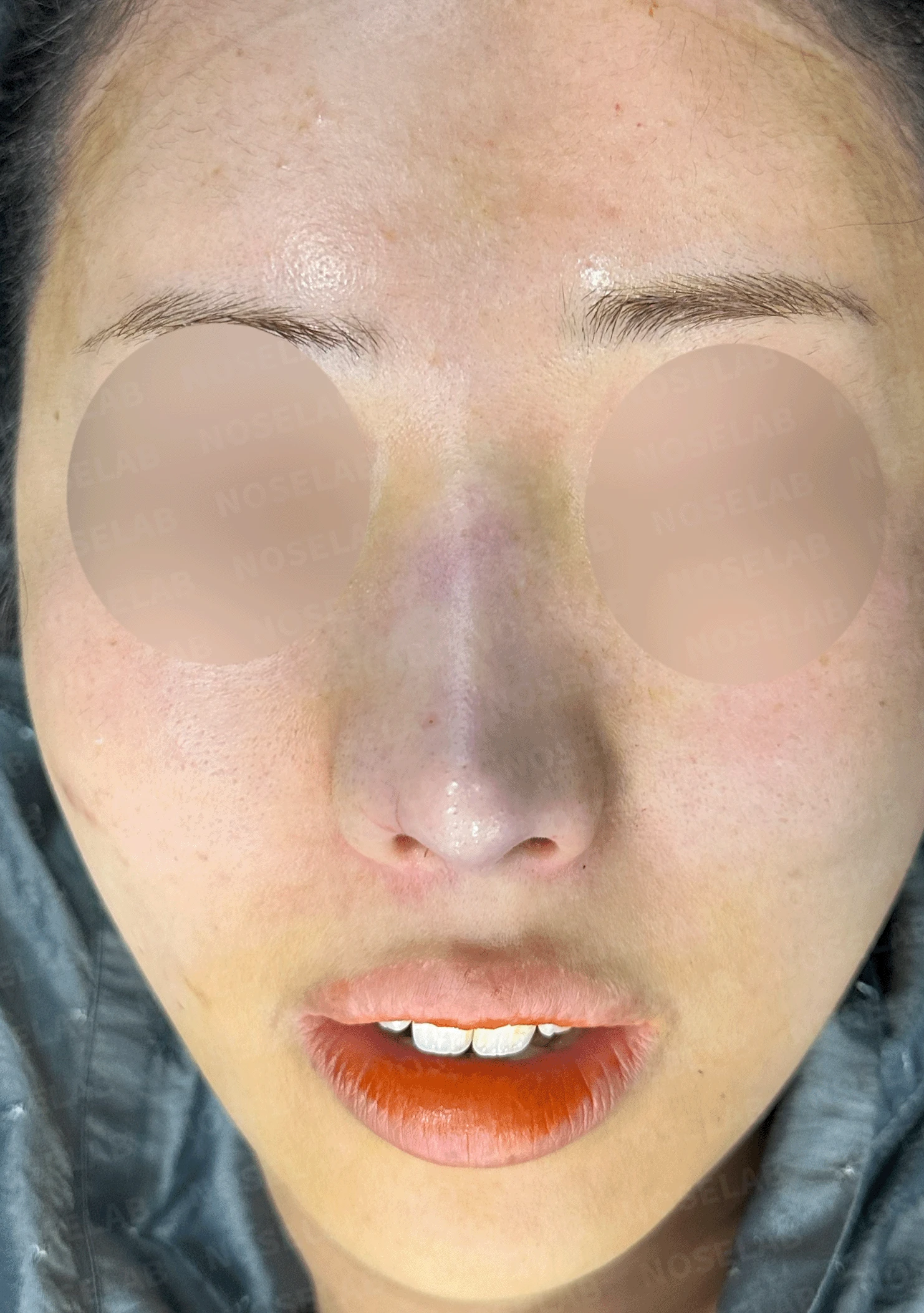 인위적인 코에서 자연스러운 아름다움으로 - 맞춤형 코 재건술 사례 — 본문 사진 8