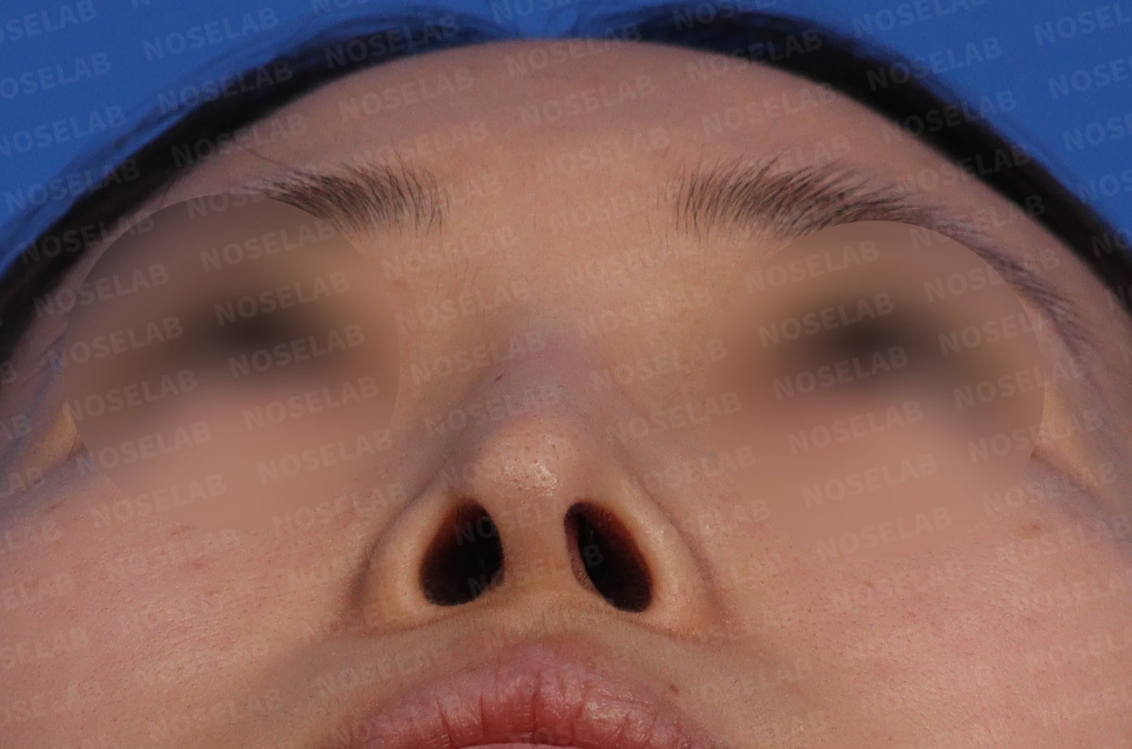 피부가 얇고 작은 들창코의 비대칭과 기능 교정 방법 — 콧구멍 사진