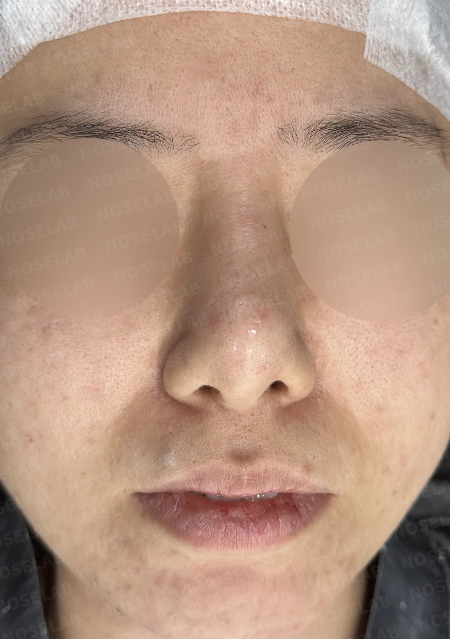 이전 수술 뒤 코가 딱딱해지고 짧아지는 구축, 왜 생기고 어떻게 재건하나 — 수술 전 / 수술 직후 0일 직후 사진은 부기가 있는 상태로 최종 결과와 다를 수 있습니다.