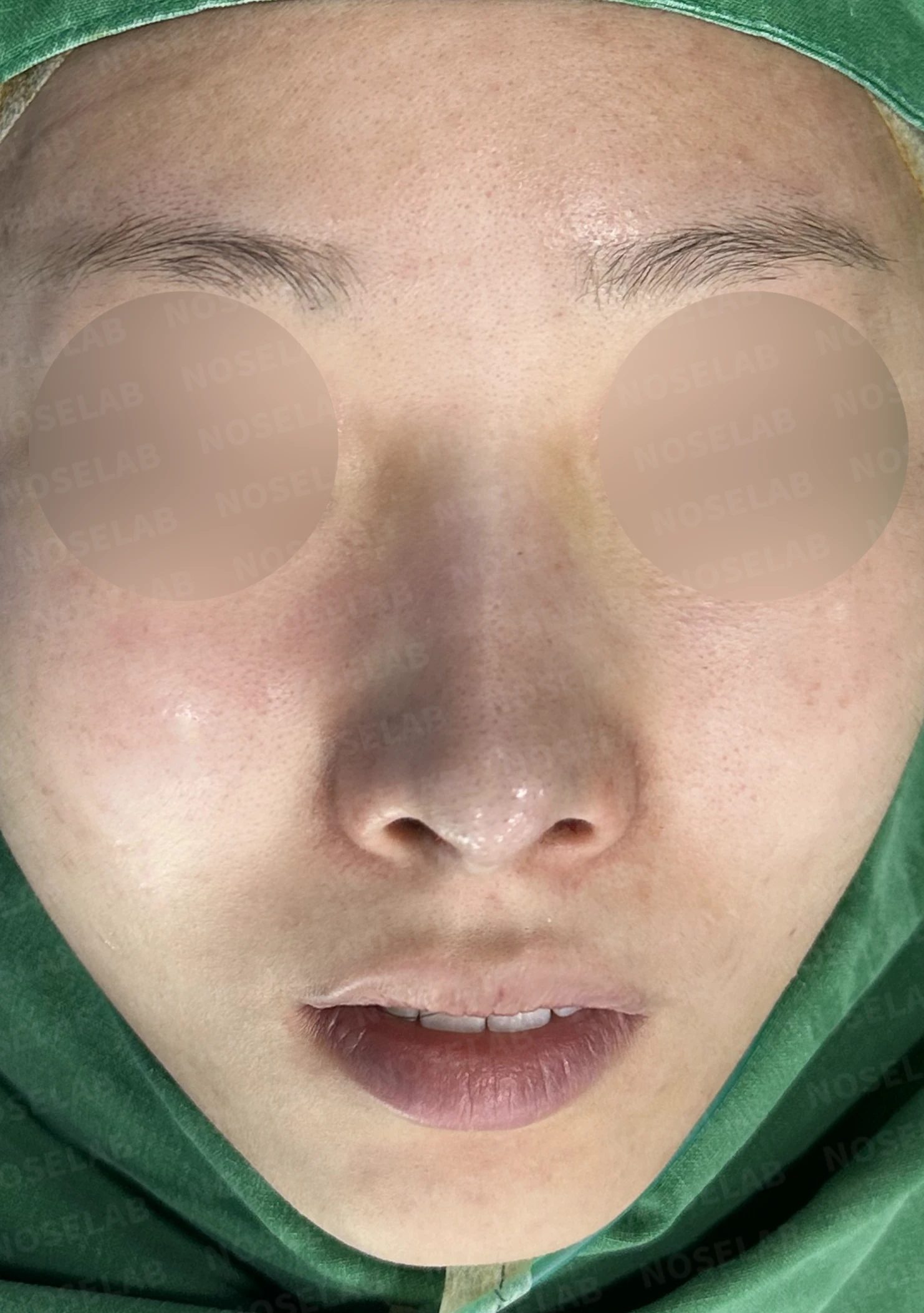 길고 처진 코, 휜코 교정과 코막힘까지 한 번에 해결한 재수술 사례 — 전(좌) 직후(후)