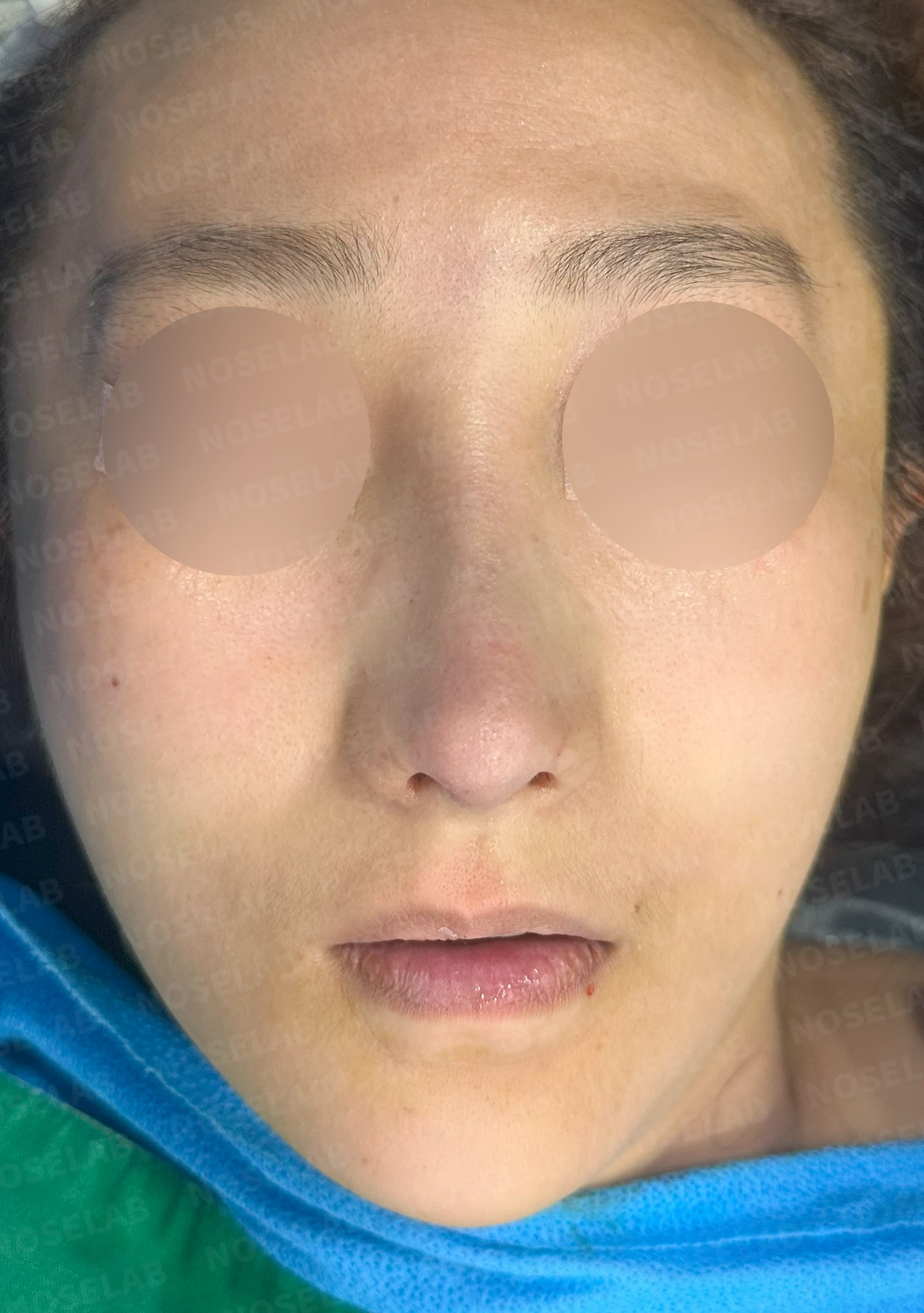 코가 한쪽으로 휘어 보이고 밤에 막히는 이유, 비중격 재건과 코막힘 개선 — 본문 사진 8
