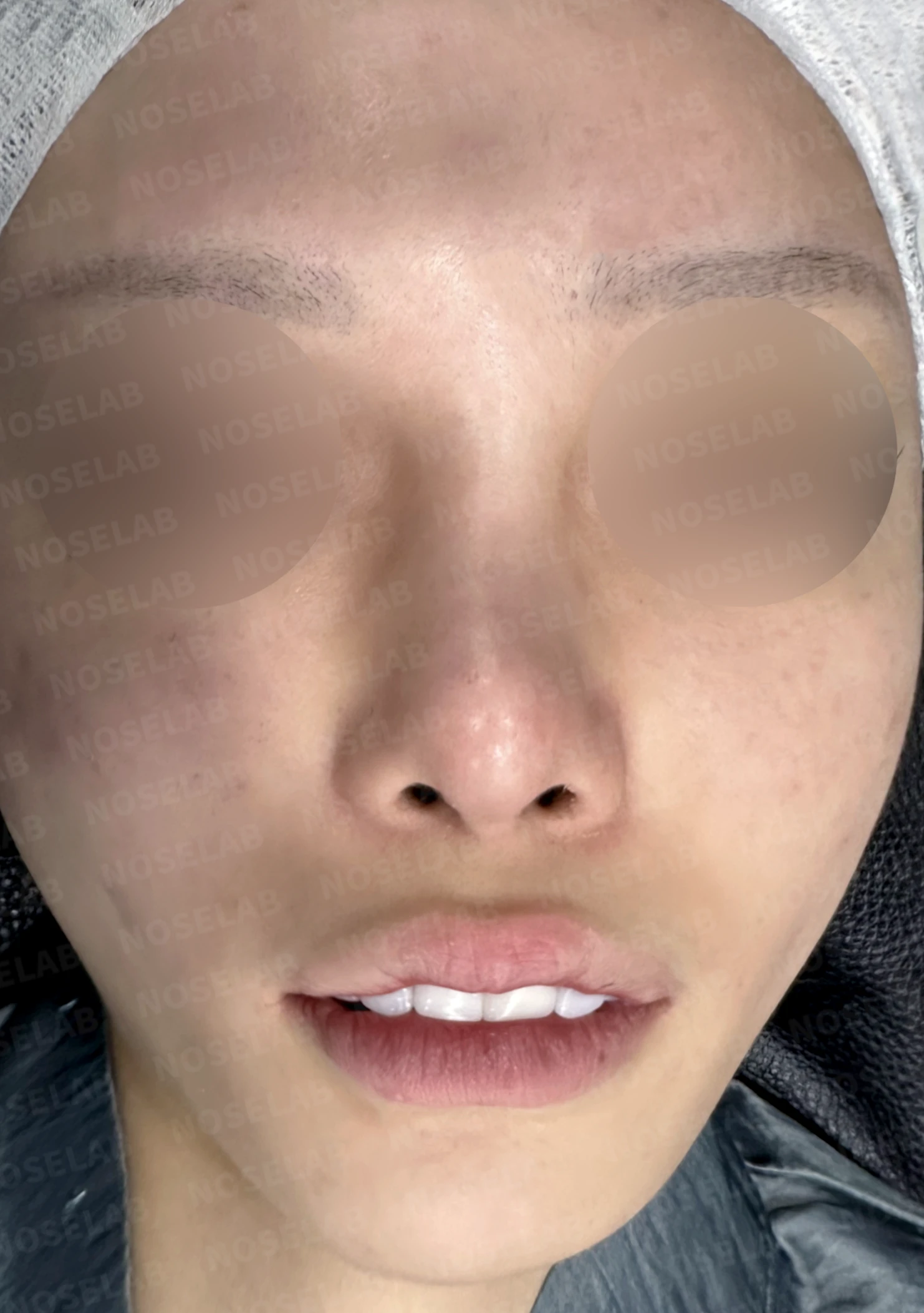 심한 비중격 만곡과 높은 콧대 시작점, 기증늑연골로 정밀 재건 — 전(좌) 직후(후)