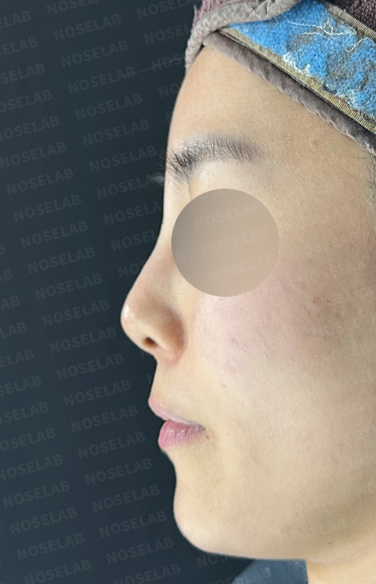 여러 차례 받은 코필러가 남긴 퍼진 코와 코막힘, 어떻게 정리하나 — 수술 전 / 수술 직후 0일 직후 사진은 부기가 있는 상태로 최종 결과와 다를 수 있습니다.