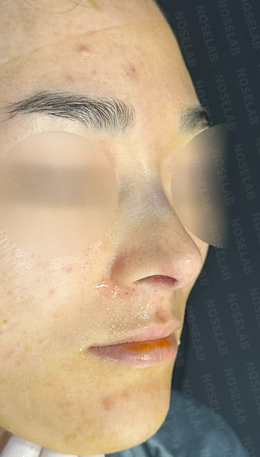 매부리코, 코막힘 개선 코성형 방법 — 수술 직후 0일 정면, 비스듬한 측면, 측면 직후 사진은 부기가 있는 상태로 최종 결과와 다를 수 있습니다.