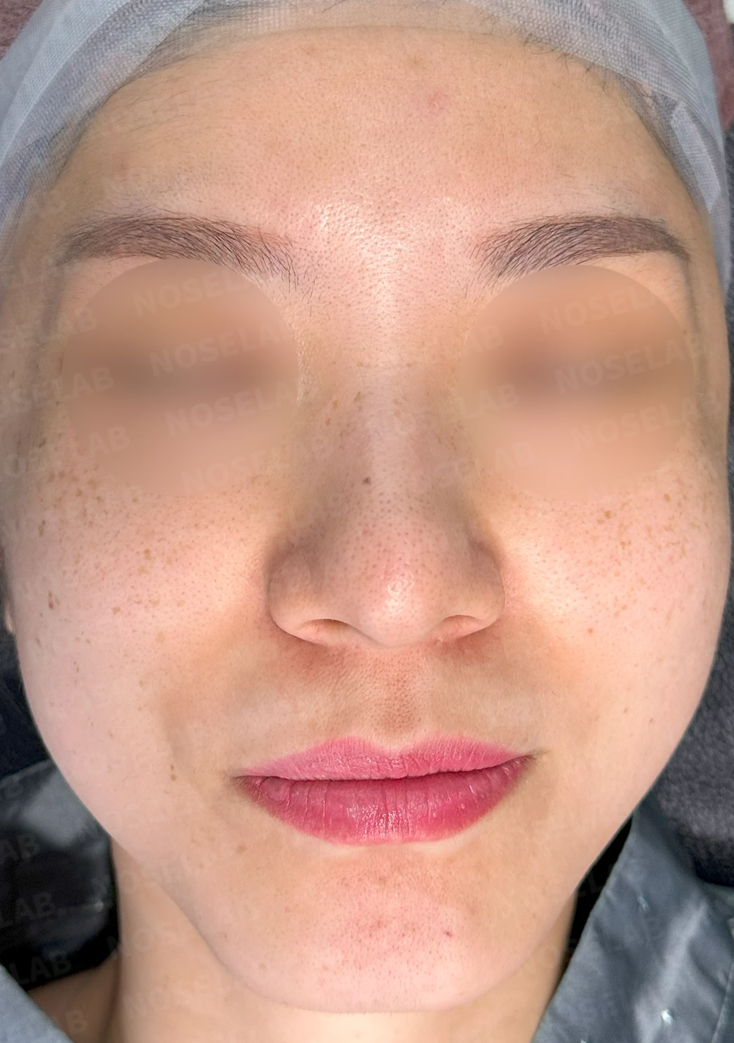 복코, 퍼진코 교정 방법 — 수술 전 / 수술 직후 0일 직후 사진은 부기가 있는 상태로 최종 결과와 다를 수 있습니다.