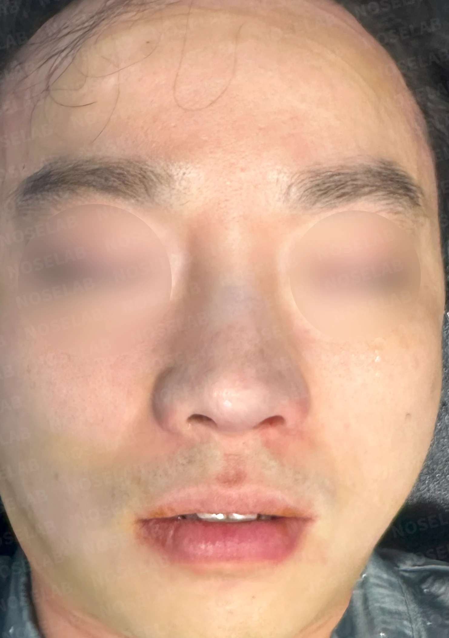 복코와 퍼진 코의 코성형 방법 — 수술 전 / 수술 직후 0일 직후 사진은 부기가 있는 상태로 최종 결과와 다를 수 있습니다.