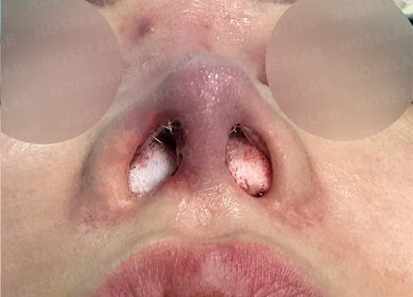 긴코 교정은 어떻게 할까요? — 수술 전 / 수술 직후 0일 직후 사진은 부기가 있는 상태로 최종 결과와 다를 수 있습니다.