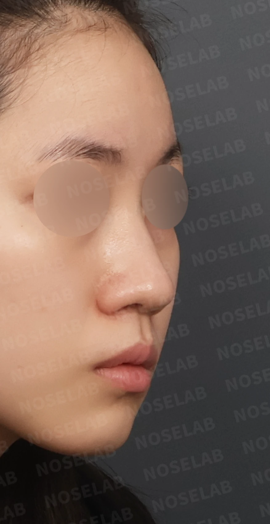 복코와 주먹코, 자가늑연골로 얄쌍하고 여성스러운 코 완성 — 디자인 상담 우측 측면, 비스듬한 측면, 비공 사진입니다.