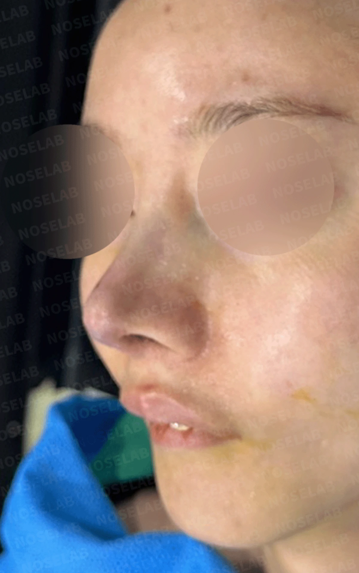 실리콘 보형물이 코끝 피부를 뚫고 나오려 할 때, 왜 생기고 어떻게 재건하나 — 본문 사진 18