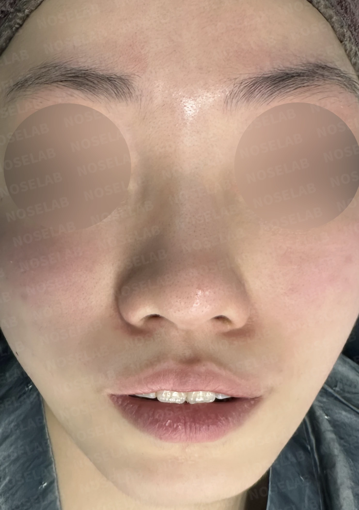 복코와 주먹코, 자가늑연골로 얄쌍하고 여성스러운 코 완성 — 전(좌) 직후(후)