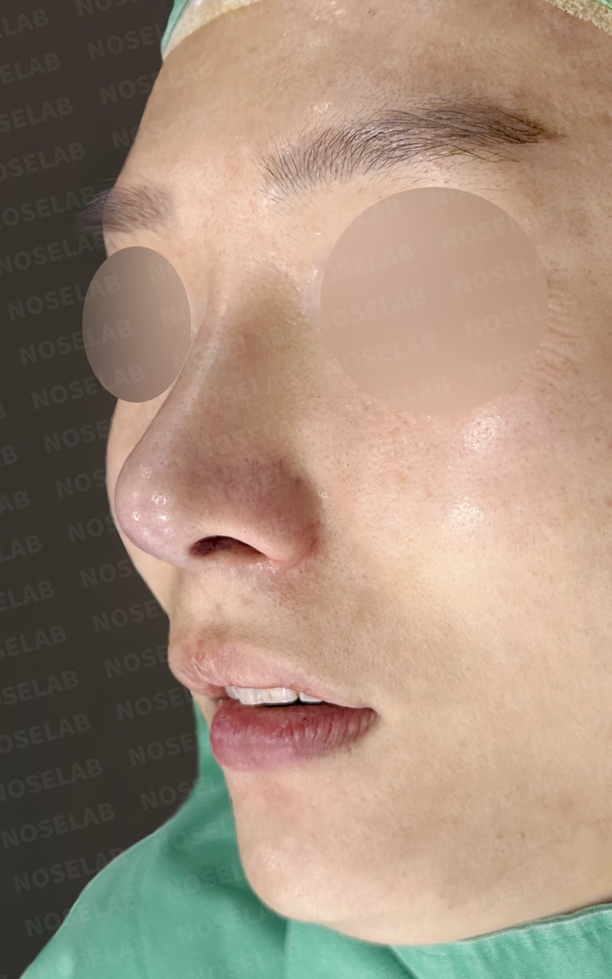 한쪽 비골이 함몰되면 왜 코가 휘어 보이는가, 절골 복원과 비중격 재건 — 수술 전 / 수술 직후 0일 직후 사진은 부기가 있는 상태로 최종 결과와 다를 수 있습니다.