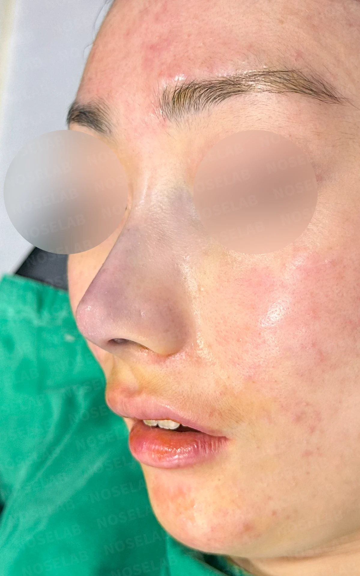 코끝이 뭉툭하게 퍼지고 코가 휘어 보이는 이유, 늑연골 재건은 어떻게 하나 — 수술 전 / 수술 직후 0일 직후 사진은 부기가 있는 상태로 최종 결과와 다를 수 있습니다.