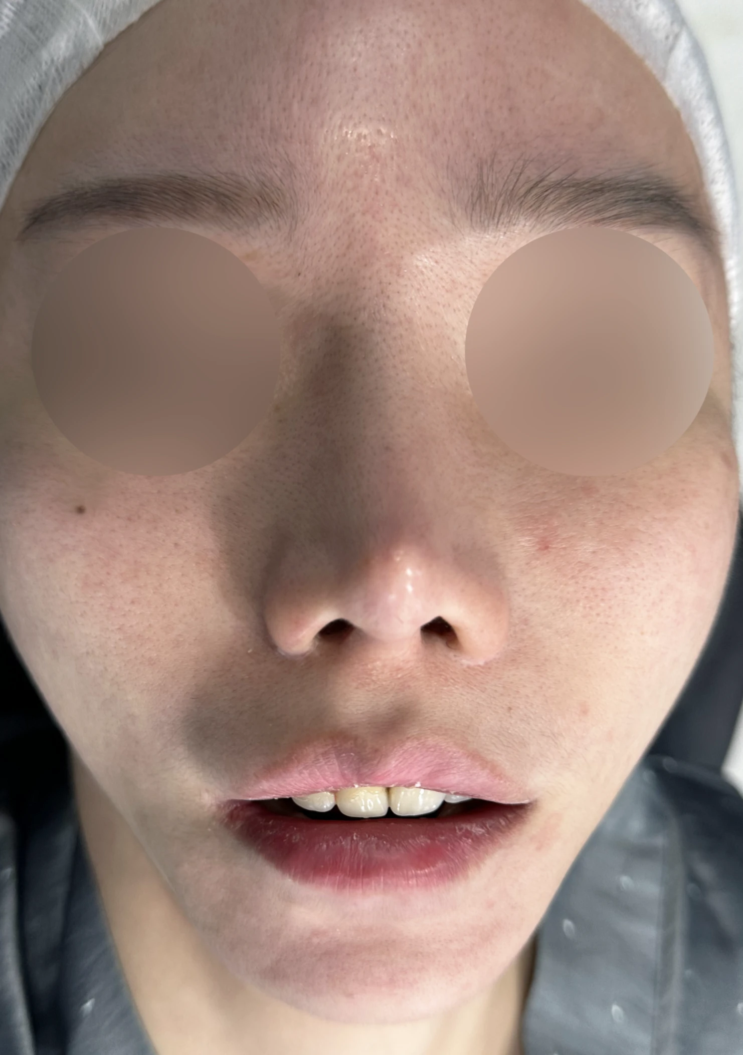 들린코와 비공 비대칭, 기증늑연골로 정교하게 교정한 코재수술 — 전(좌) 직후(후)