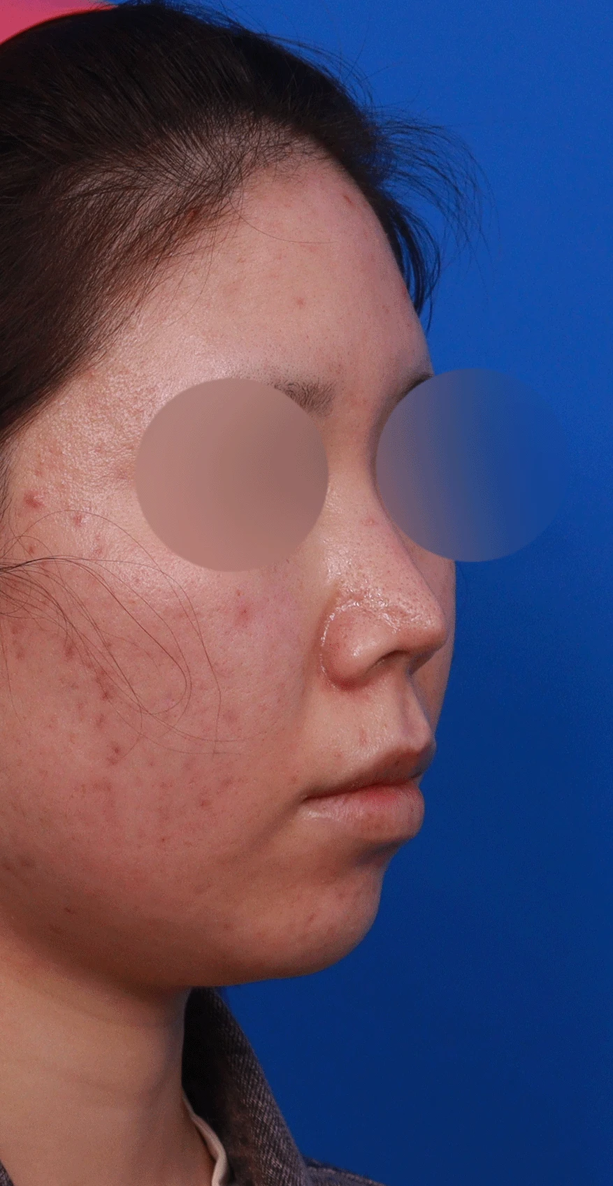 콧구멍을 막는 종괴가 생기는 이유, 제거와 재건은 어떻게 하나 — 디자인 상담 우측 비스듬한 측면 , 측면 , 비공 사진입니다.
