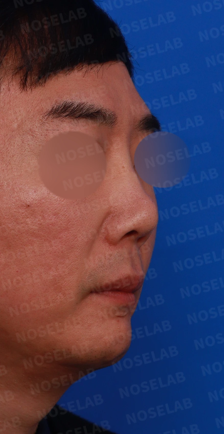 매부리코 수술 후 비대칭의 재수술 방법 — 디자인 상담 우측 비스듬한 측면, 측면, 비공 사진입니다.