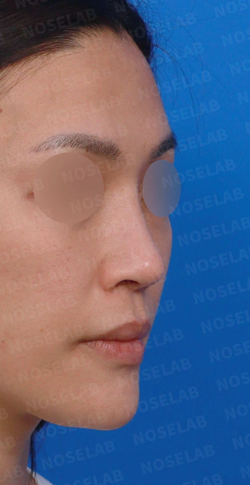 오래된 보형물 코의 코끝 지지력이 약해지는 이유와 비중격연장 재건 방법 — 디자인 상담 우측 측면, 비스듬한 측면, 비공 사진입니다.