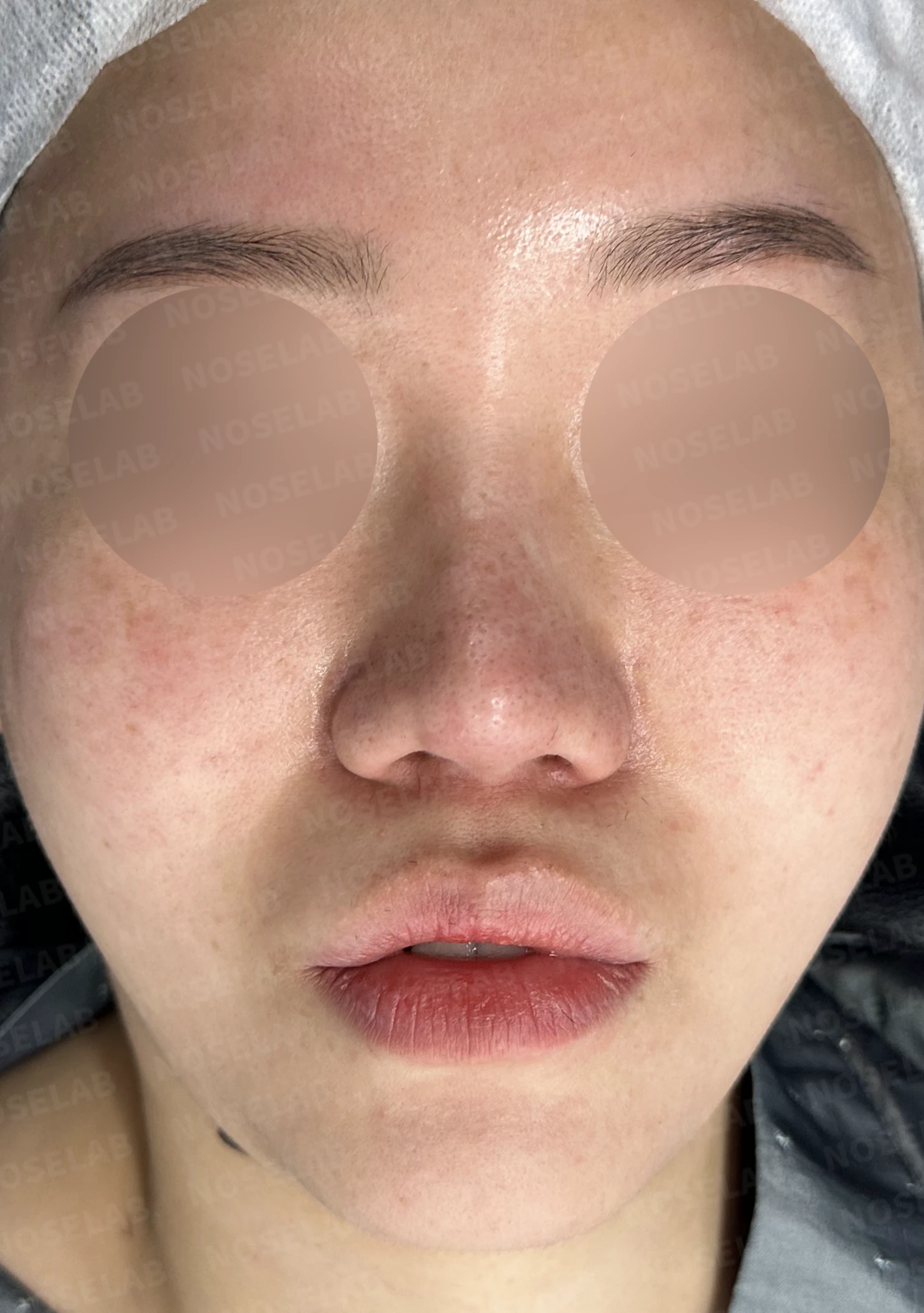 비주 함몰과 콧날개 변형, 자가늑연골을 이용한 코재수술로 자연스럽게 교정 — 전(좌) 직후(후)