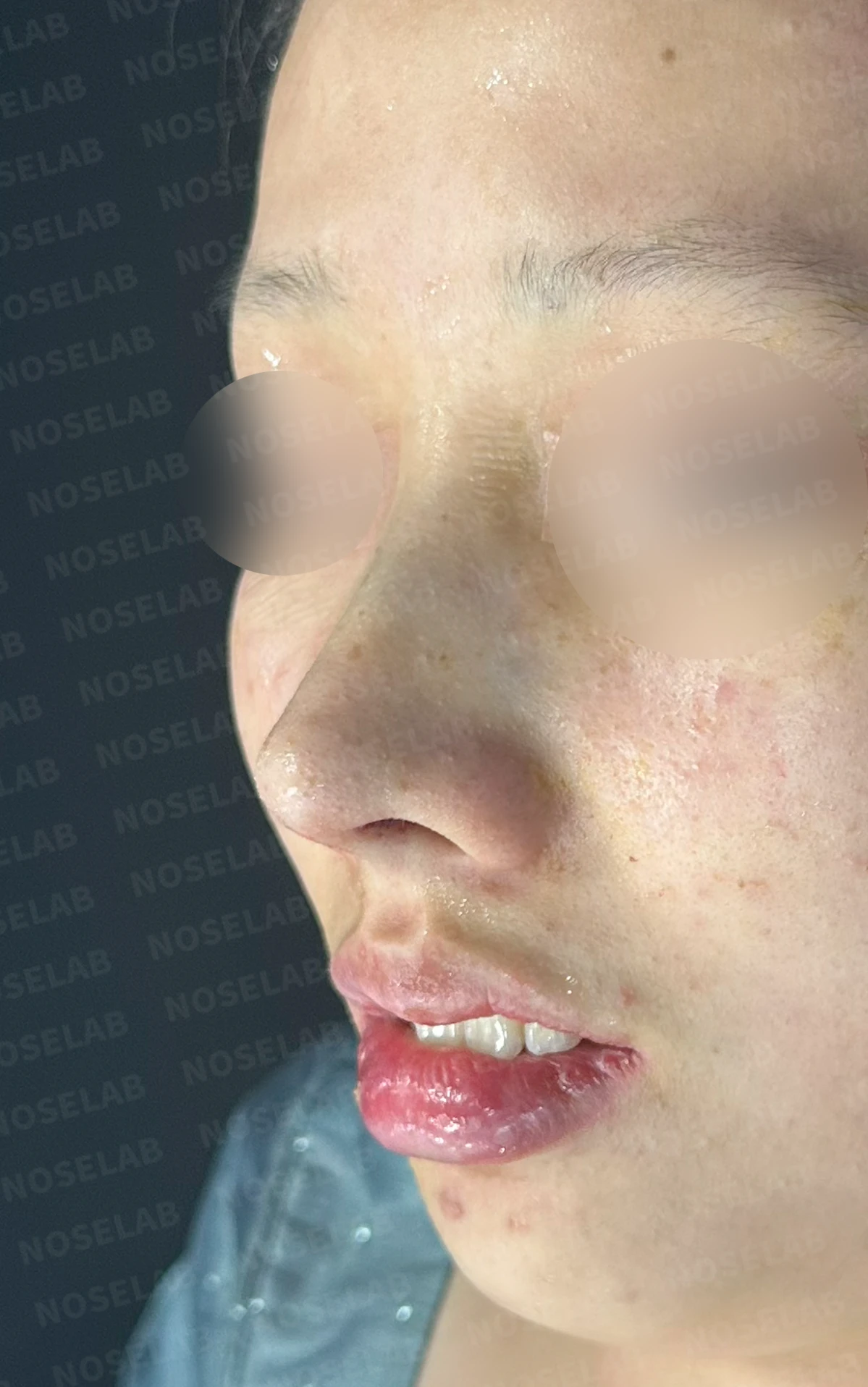 매부리코와 처진 코끝이 함께 있을 때, 콧대와 코끝의 균형 잡는 법 — 수술 전 / 수술 직후 0일 직후 사진은 부기가 있는 상태로 최종 결과와 다를 수 있습니다.