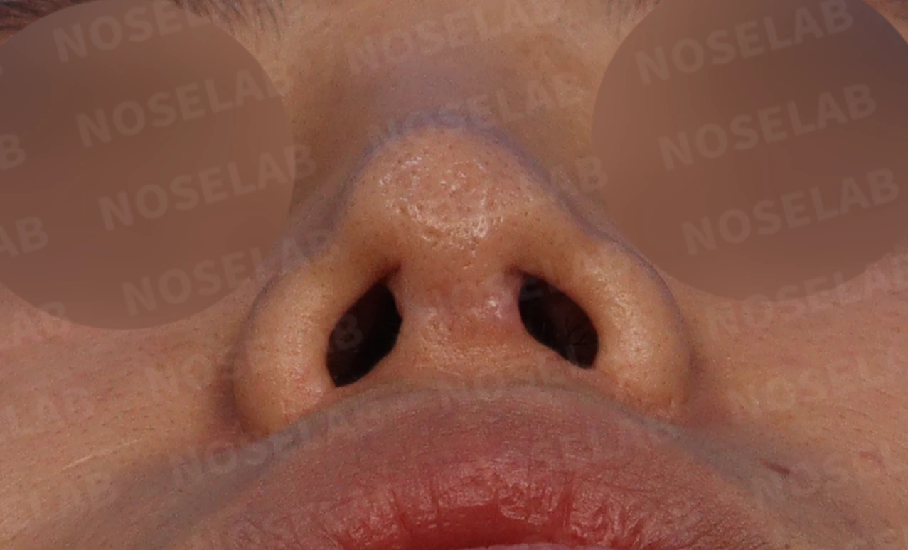 높은 콧대 시작점을 낮추는 방법 — 콧구멍 사진입니다.