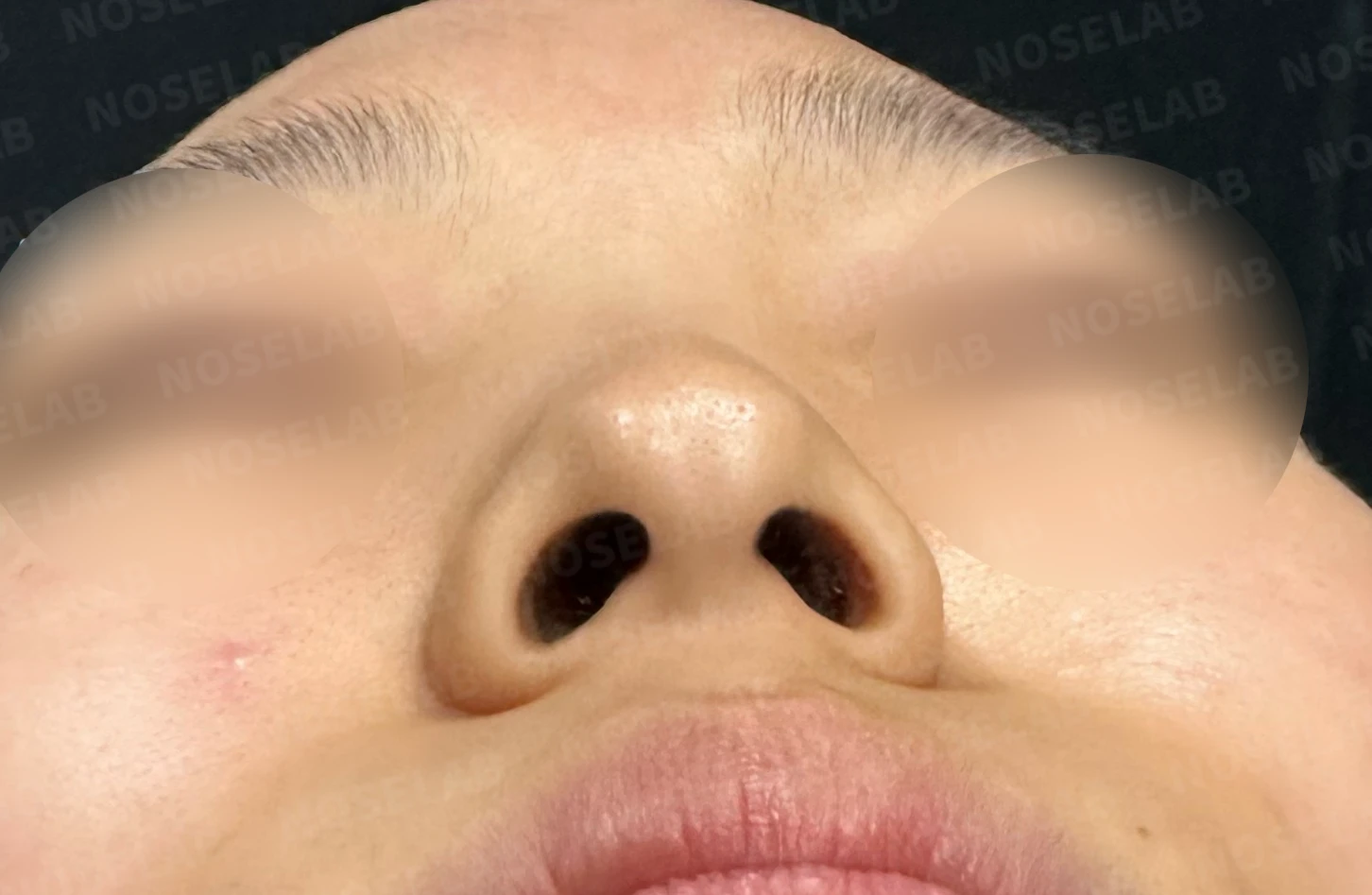 긴코·퍼진코 교정 방법 — 수술 전 / 수술 직후 0일 직후 사진은 부기가 있는 상태로 최종 결과와 다를 수 있습니다.