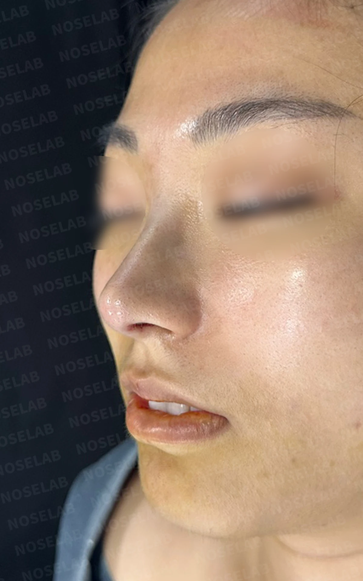 뭉툭하게 퍼진 코끝이 생기는 이유, 자가 늑연골 비중격 연장으로 직반 라인을 만드는 방법 — 수술 전 / 수술 직후 0일 직후 사진은 부기가 있는 상태로 최종 결과와 다를 수 있습니다.