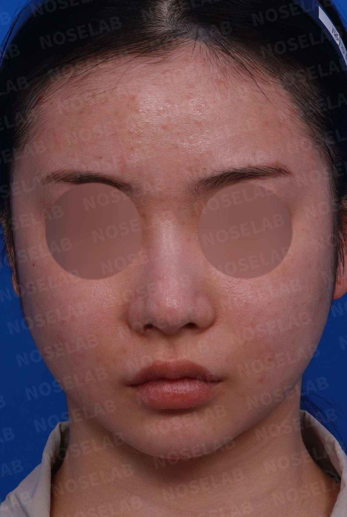 코에 주입된 필러와 실을 제거하고 재건하는 방법 — 수술전 디자인 상담 사진입니다.