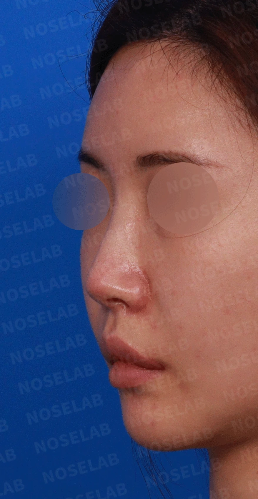 이전 수술로도 달라지지 않는 뭉툭한 코끝, 원인과 재건 방법 — 디자인 상담 정면 , 좌측 비스듬한 측면 , 측면 사진입니다.