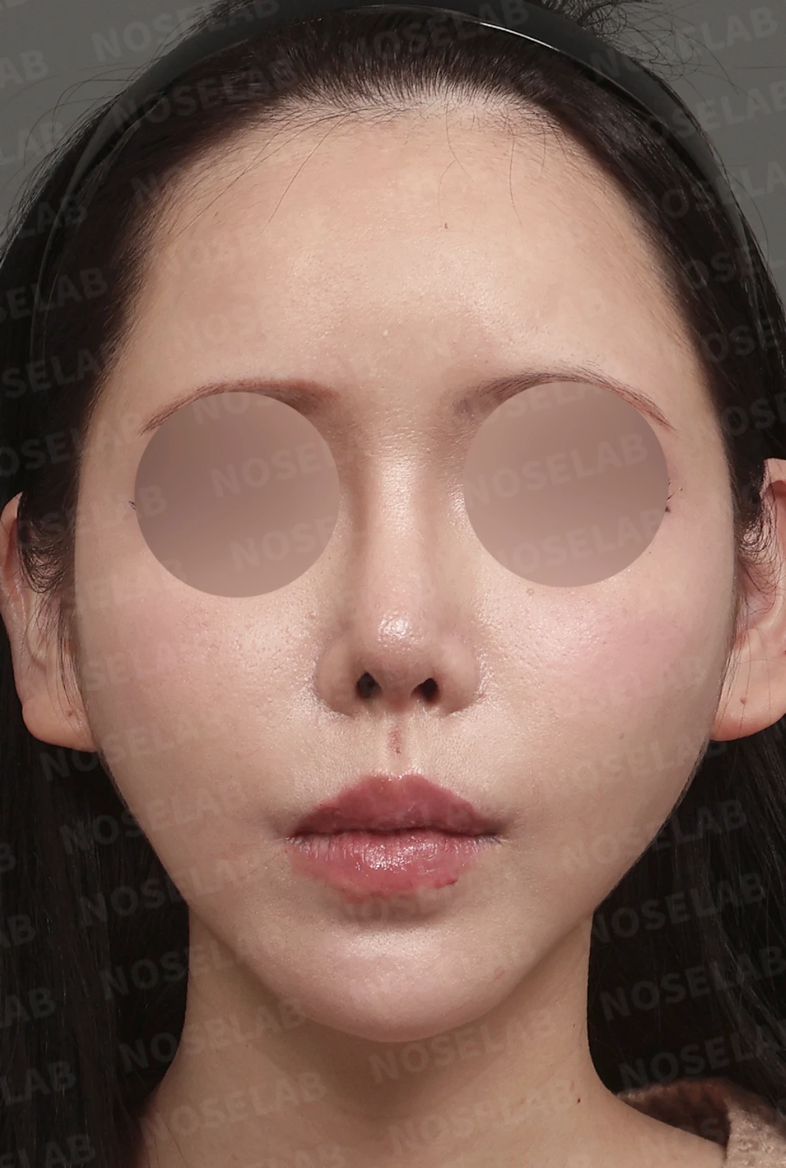들리고 찌그러진 코끝, 자가늑연골로 비중격 재건한 코성형 사례 — 디자인 상담 정면, 좌측 측면, 비스듬한 측면 사진