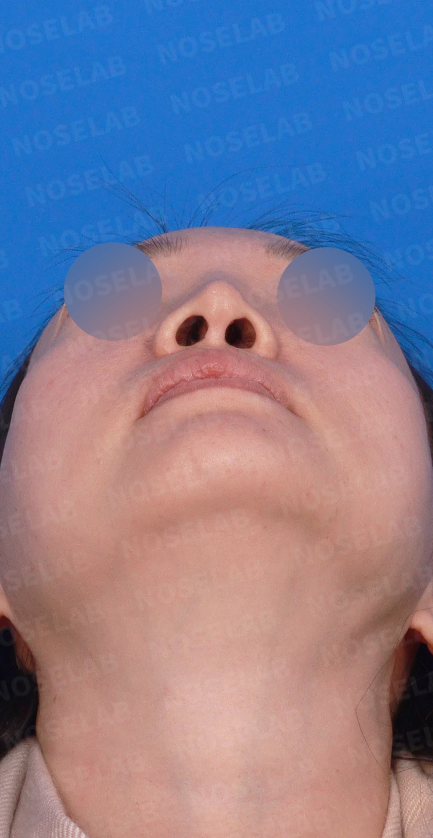 비중격이 한쪽으로 무너지면 코가 휘고 숨이 막히는 이유, 자가늑연골 재건 방법 — 디자인 상담 우측 측면, 비스듬한 측면, 비공 사진입니다.