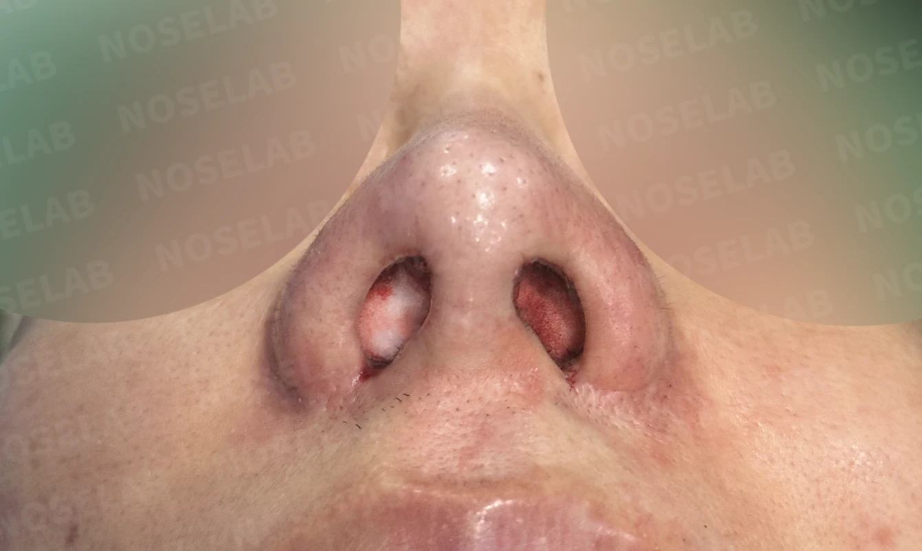 코재수술과 코막힘 교정, 기능과 심미 모두 잡은 비개방 코성형 사례 — 전(좌) 직후(후)