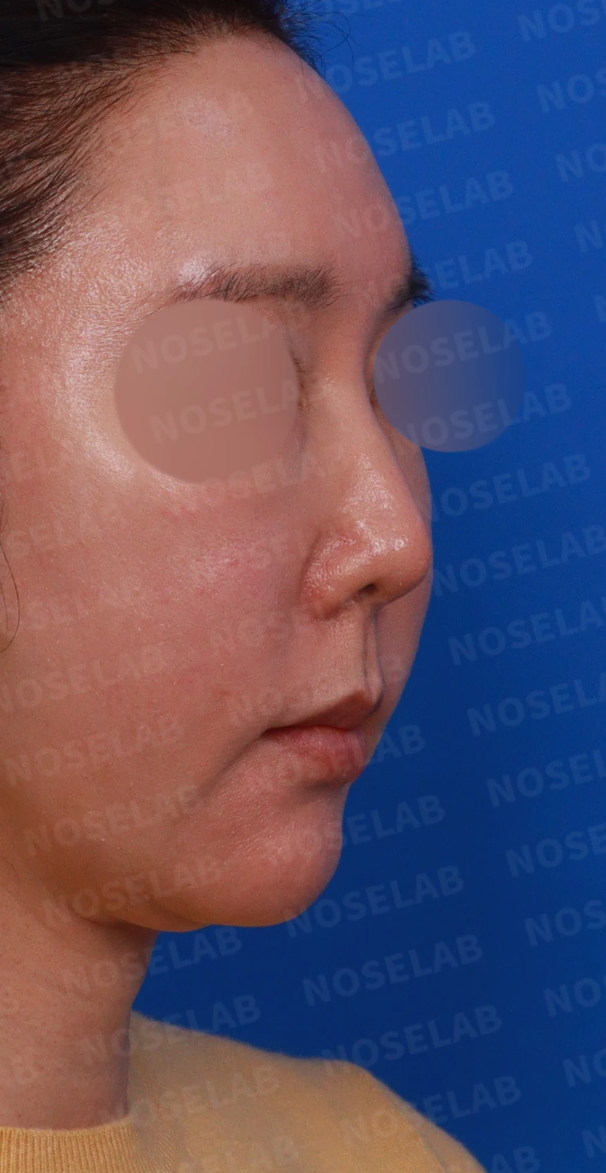 매부리를 깎은 뒤 다시 매부리가 보이고 콧구멍이 드러나는 이유 — 디자인 상담 정면, 좌측 측면, 측면 사진